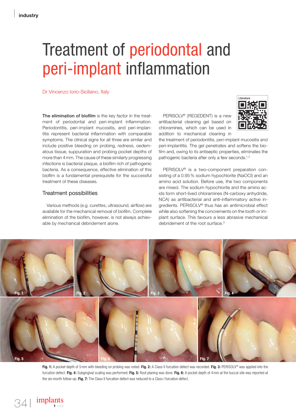 Treatment of Periodontal and Peri-Implant Inflammation