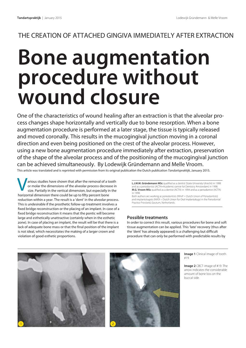 Bone Augmentation Procedure Without Wound Closure