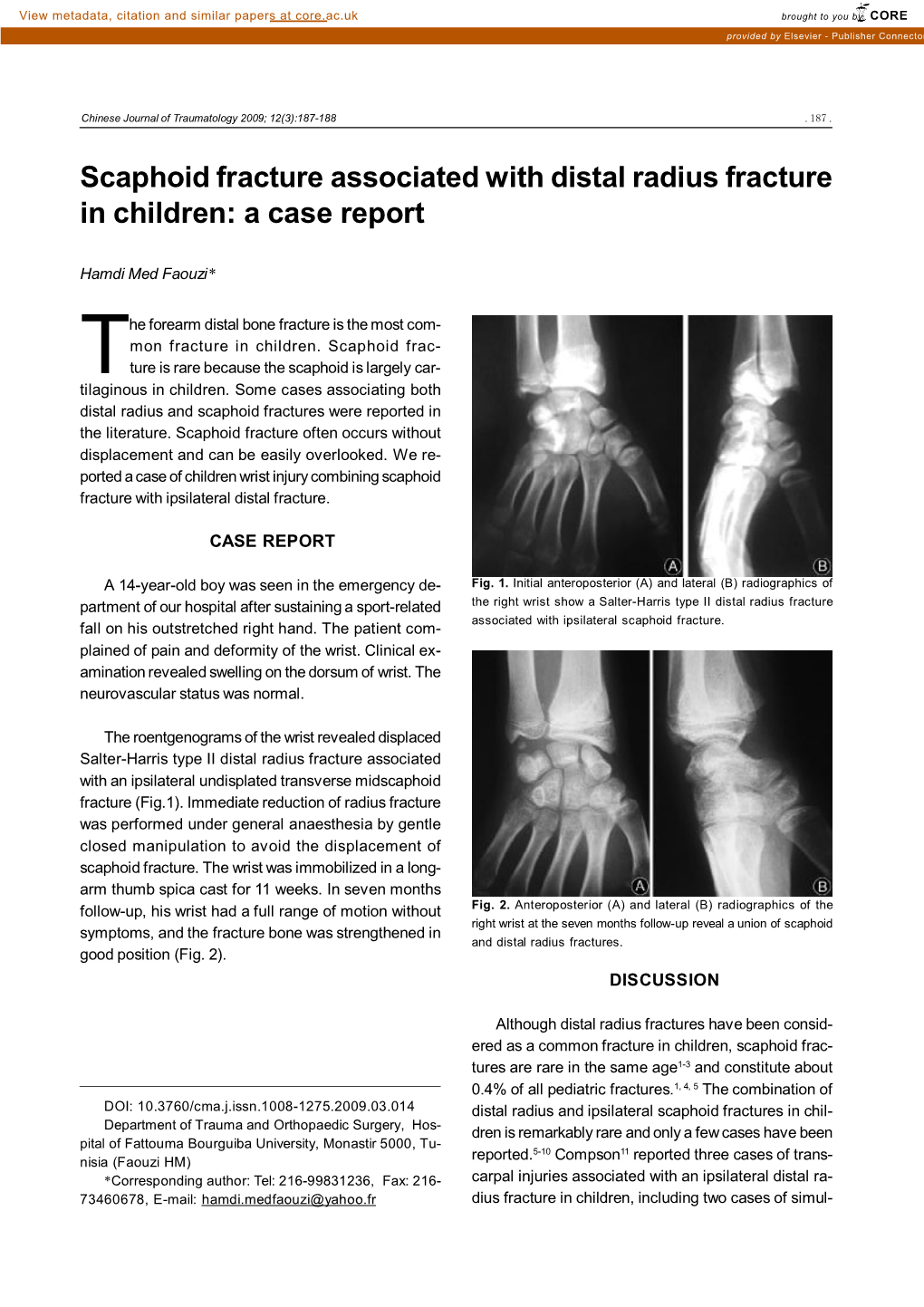 Scaphoid Fracture Associated with Distal Radius Fracture in Children: a Case Report