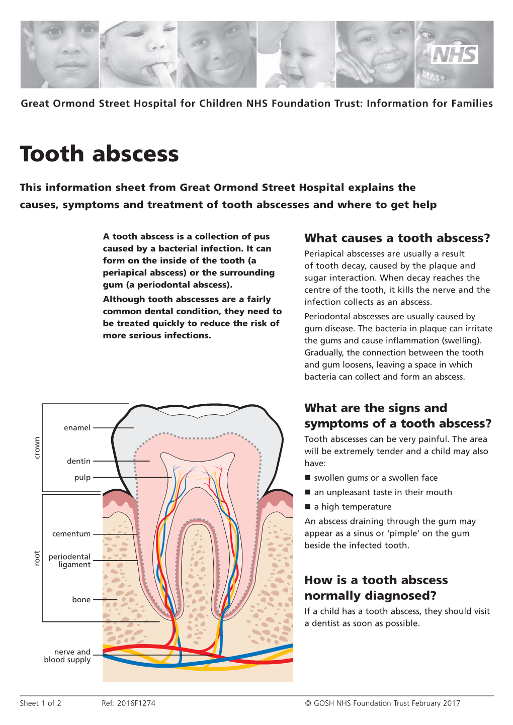 Tooth Abscess