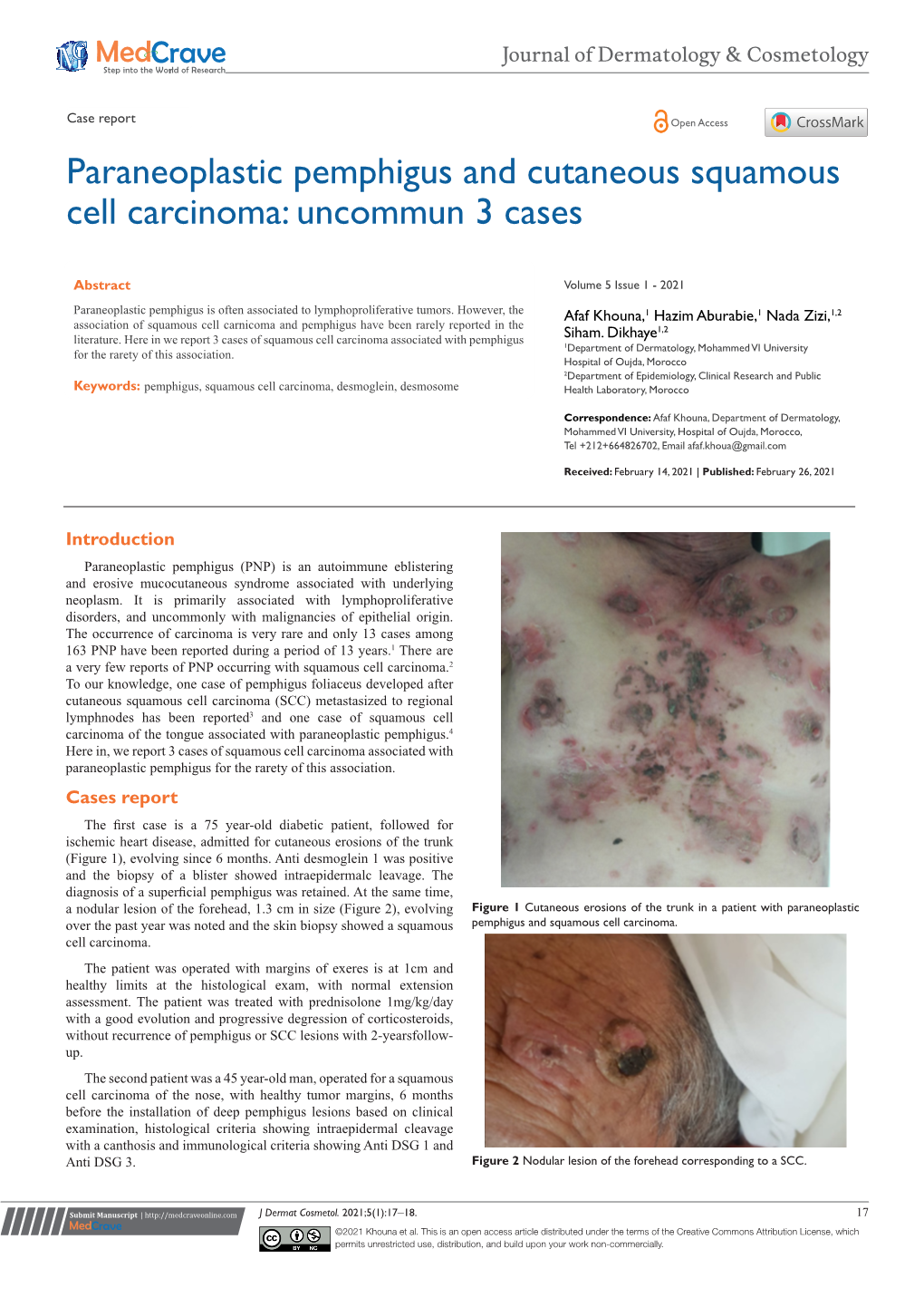 Paraneoplastic Pemphigus and Cutaneous Squamous Cell Carcinoma: Uncommun 3 Cases