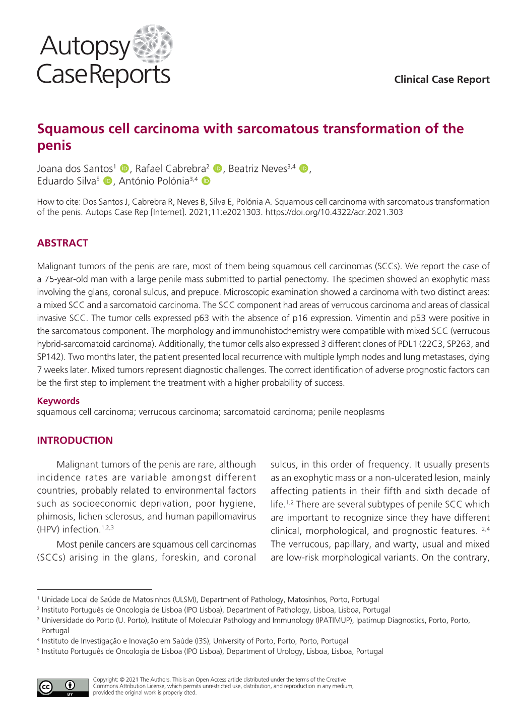 Squamous Cell Carcinoma with Sarcomatous Transformation of the Penis