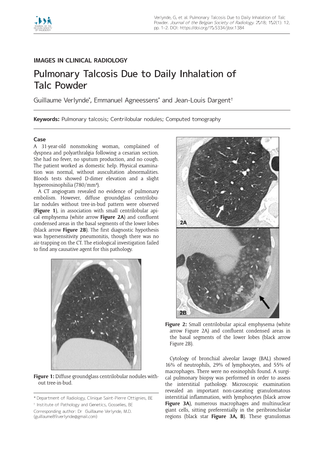 Pulmonary Talcosis Due to Daily Inhalation of Talc Powder