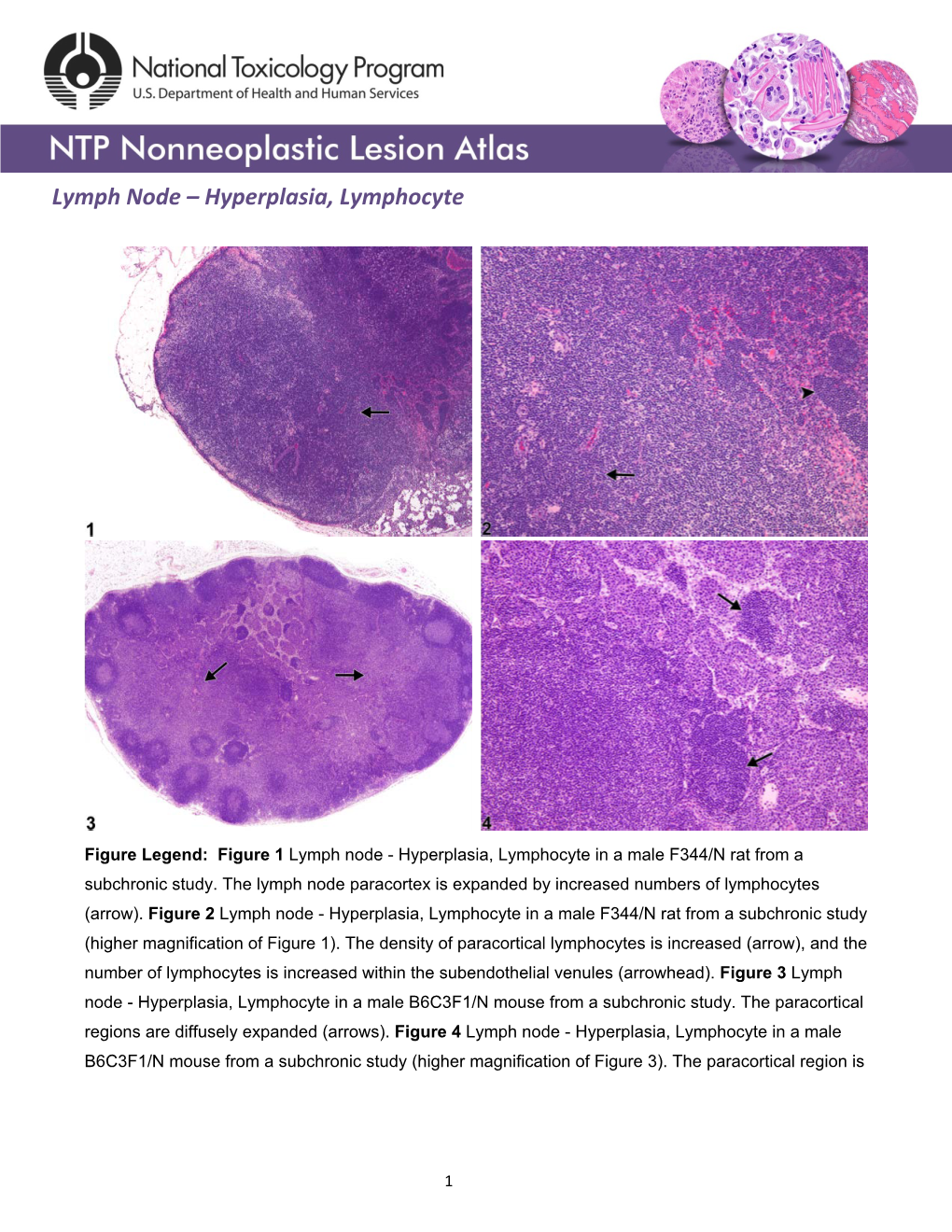 Lymph Node – Hyperplasia, Lymphocyte