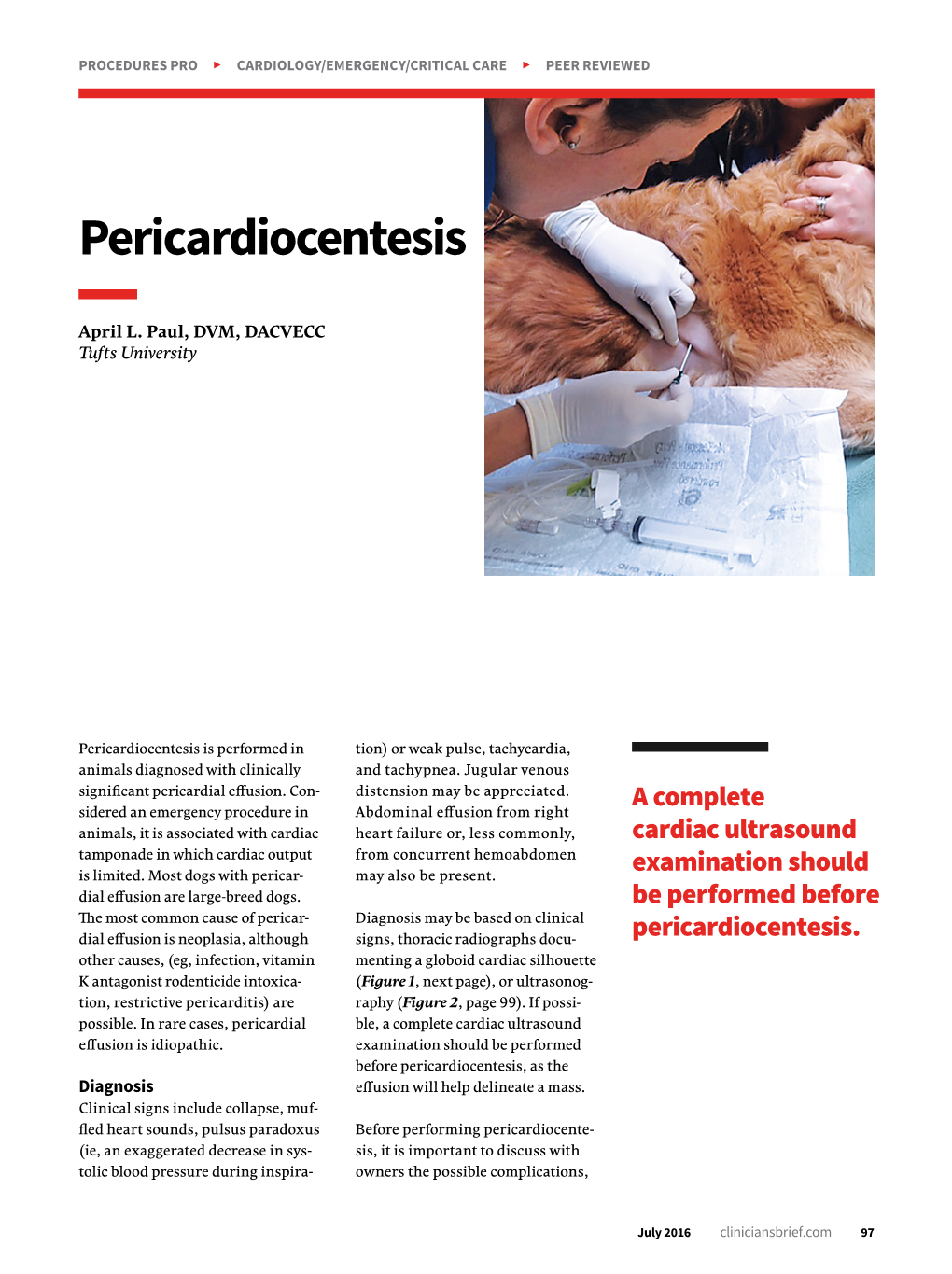 Pericardiocentesis