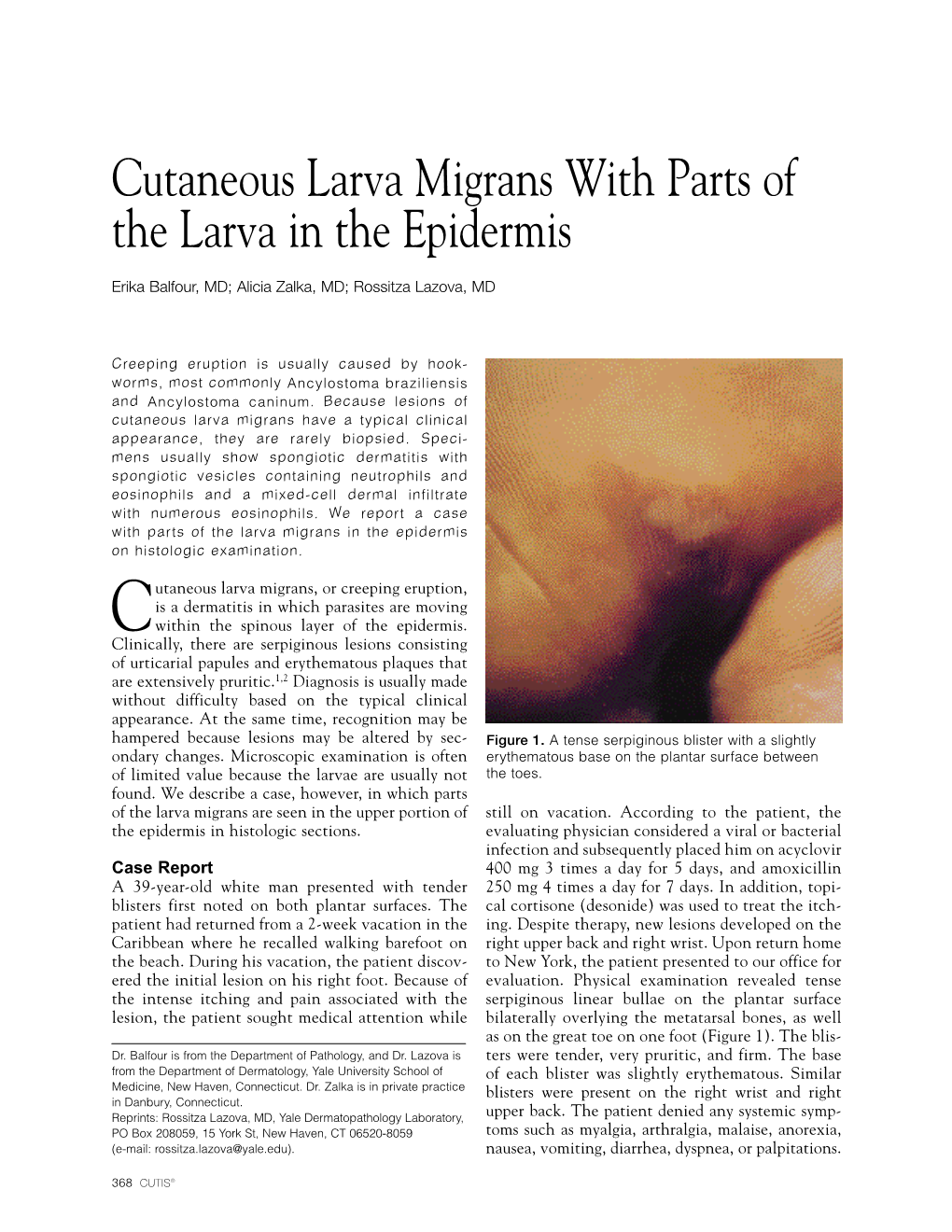 Cutaneous Larva Migrans with Parts of the Larva in the Epidermis