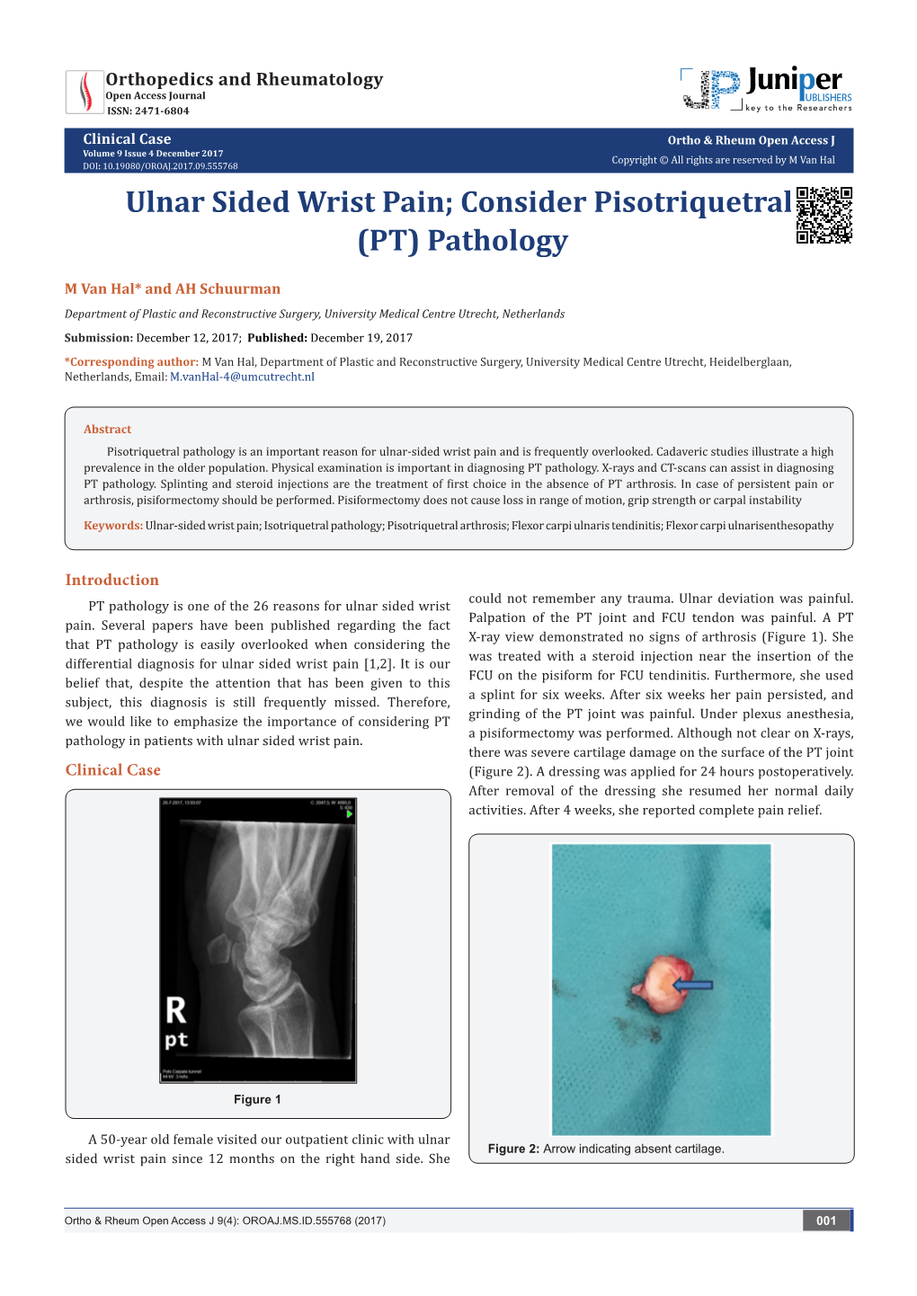 Ulnar Sided Wrist Pain; Consider Pisotriquetral (PT) Pathology