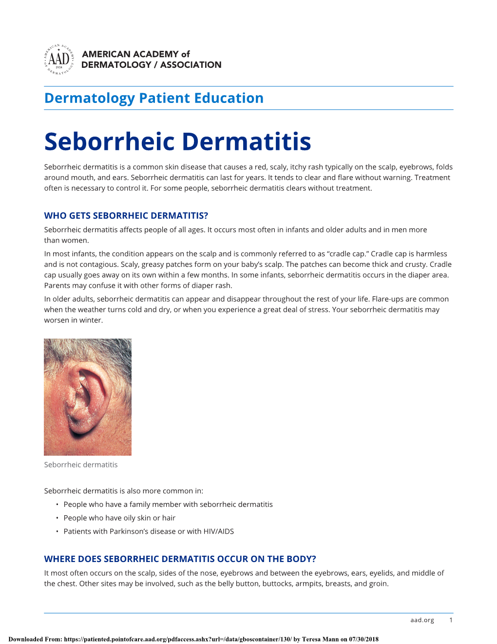 Seborrheic Dermatitis