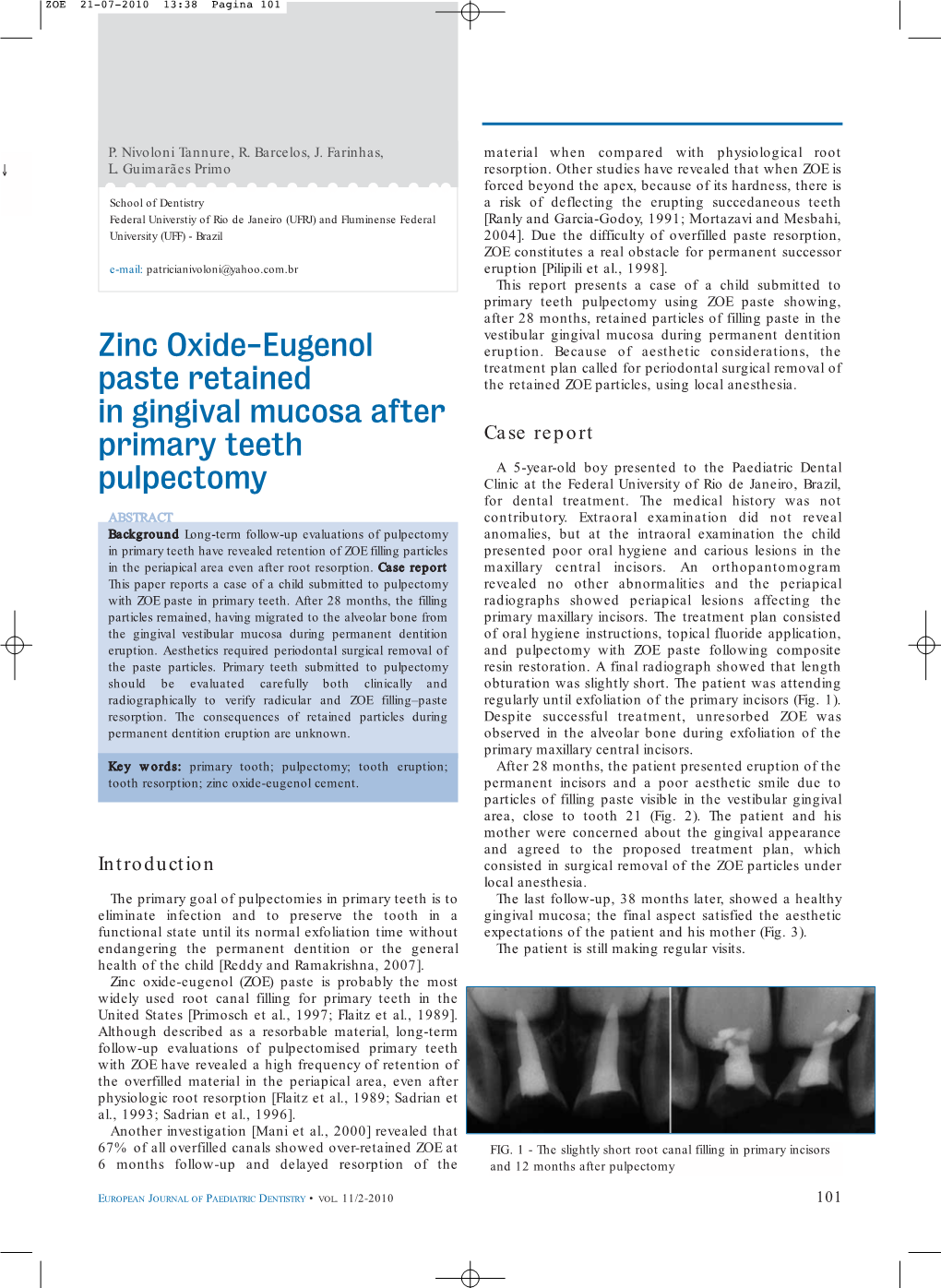 Zinc Oxide-Eugenol Paste Retained in Gingival Mucosa After Primary Teeth