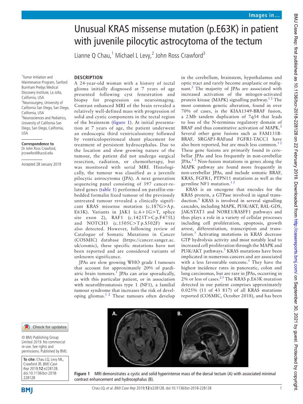 Unusual KRAS Missense Mutation (P.E63K) in Patient with Juvenile Pilocytic Astrocytoma of the Tectum Lianne Q Chau,1 Michael L Levy,2 John Ross Crawford3