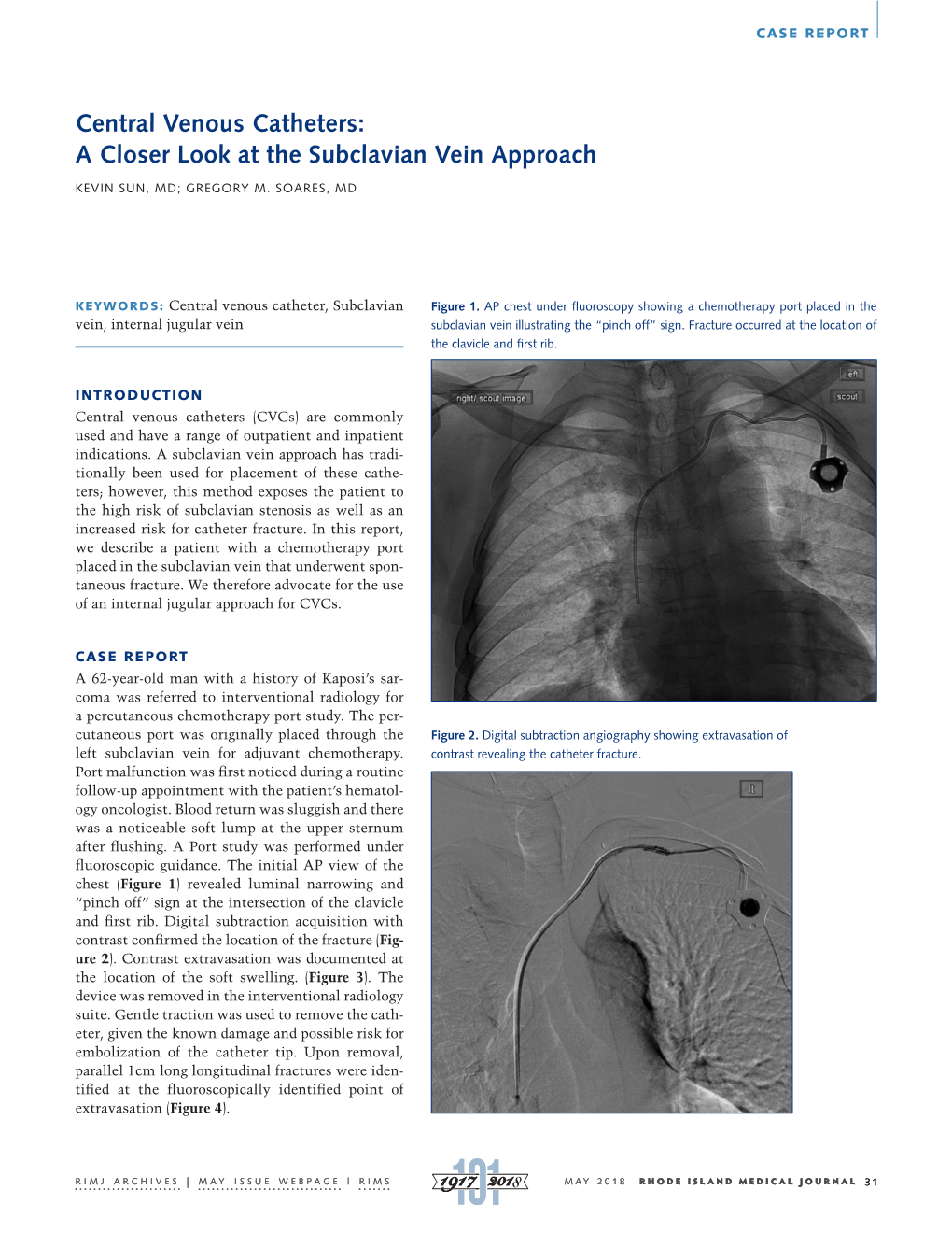 Central Venous Catheters: a Closer Look at the Subclavian Vein Approach