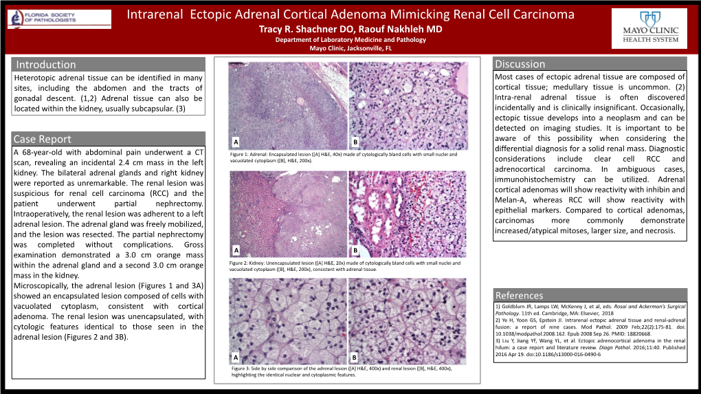 Intrarenal Ectopic Adrenal Cortical Adenoma Mimicking Renal Cell Carcinoma Tracy R