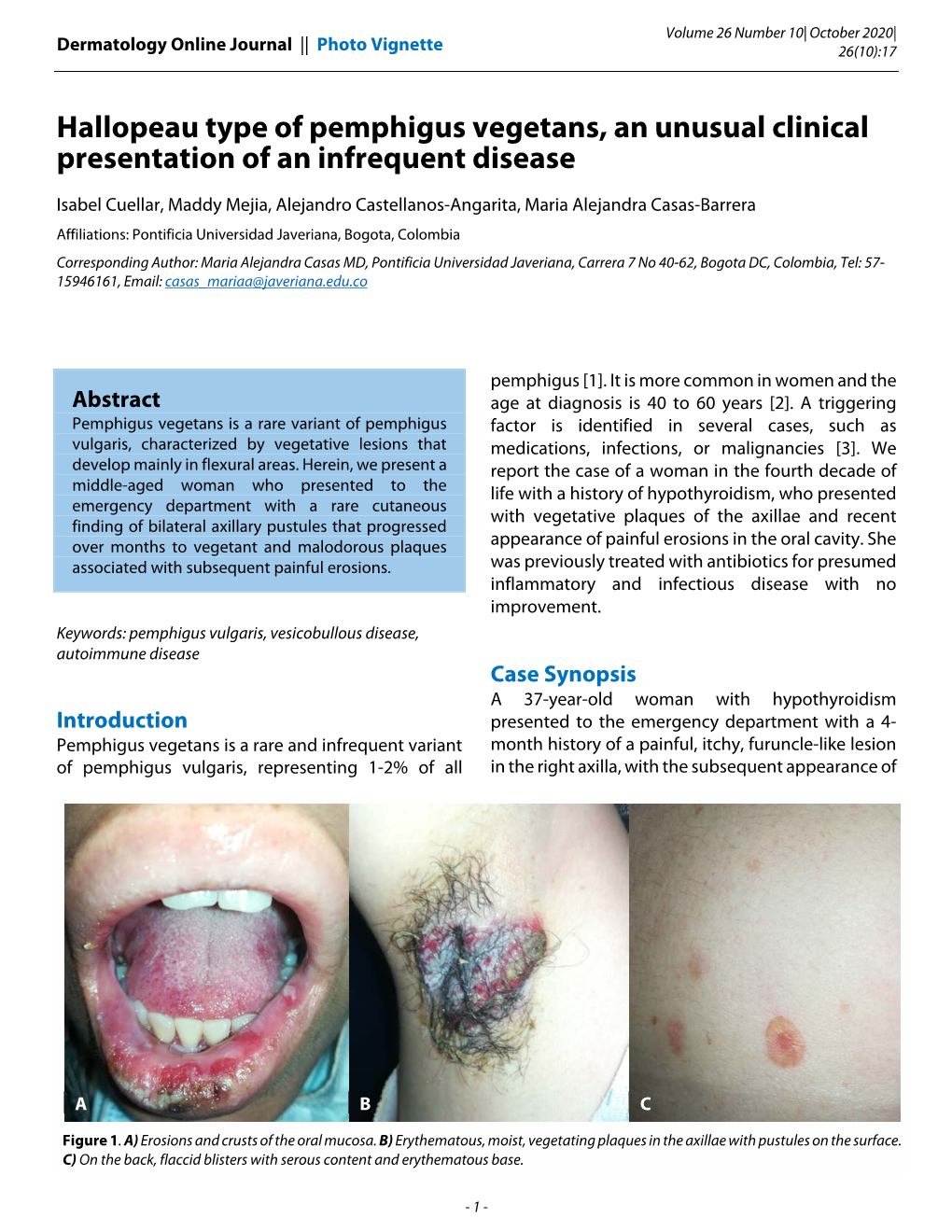 Hallopeau Type of Pemphigus Vegetans, an Unusual Clinical Presentation of an Infrequent Disease