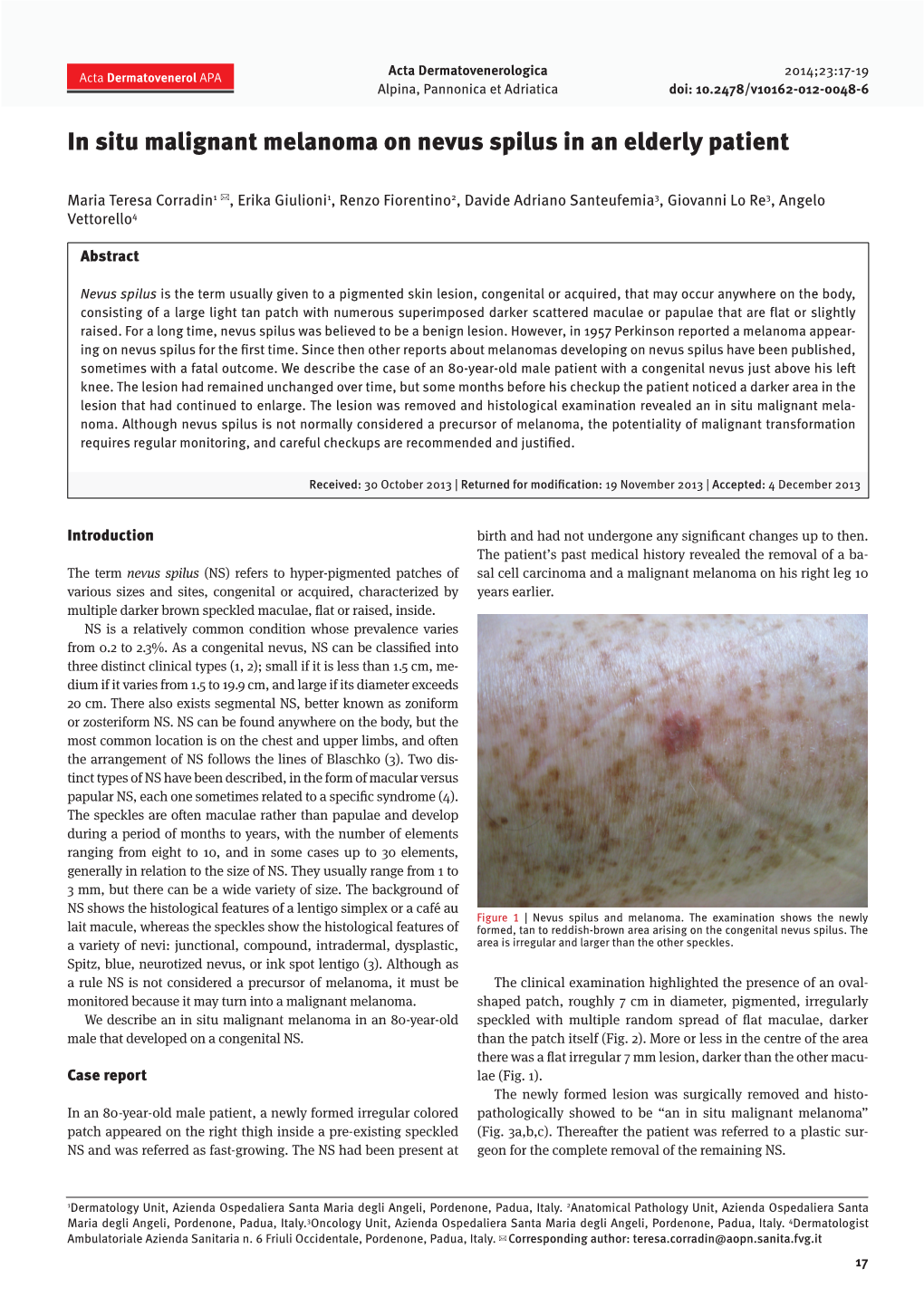 In Situ Malignant Melanoma on Nevus Spilus in an Elderly Patient