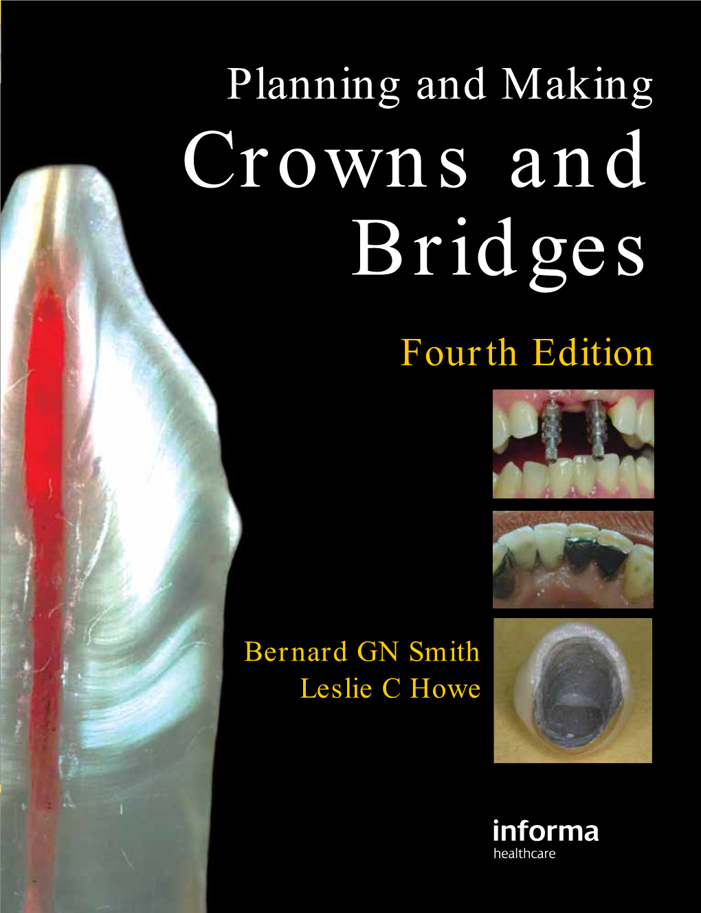 Crowns and Bridges