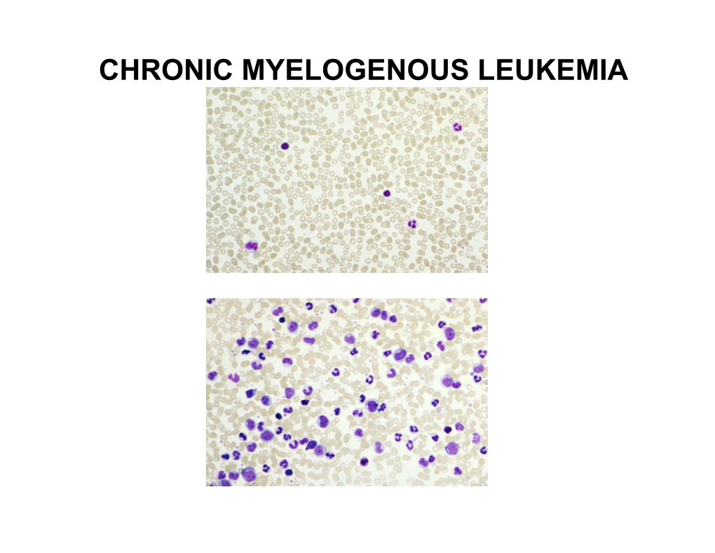 Chronic Myelogenous Leukemia Shuffling the Genetic Deck in Cml