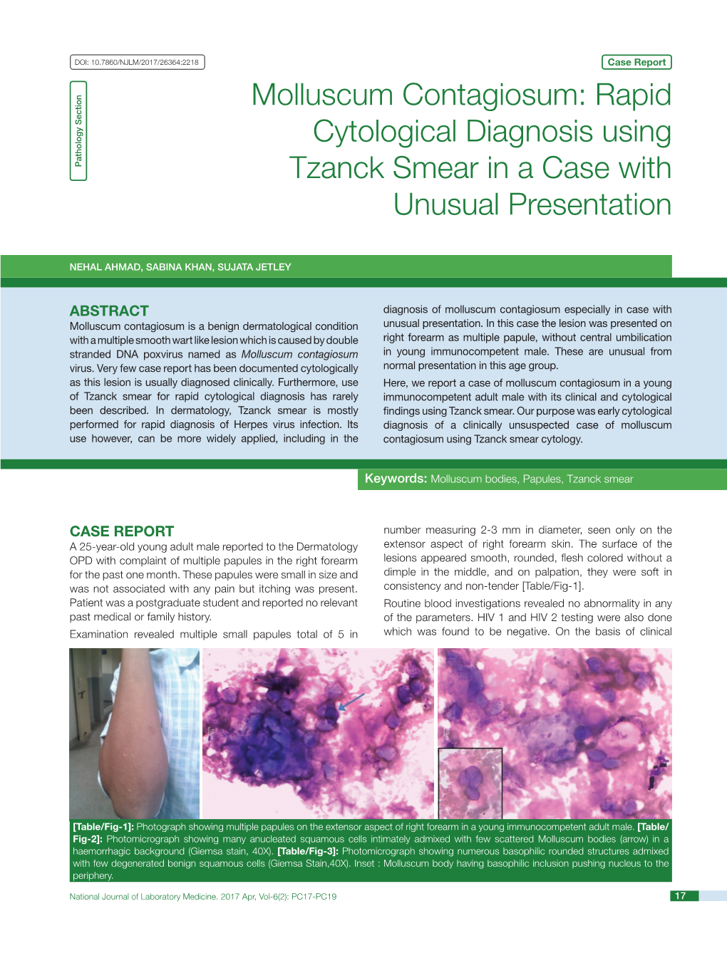 Molluscum Contagiosum: Rapid Cytological Diagnosis Using Tzanck Smear in a Case with Unusual Presentation