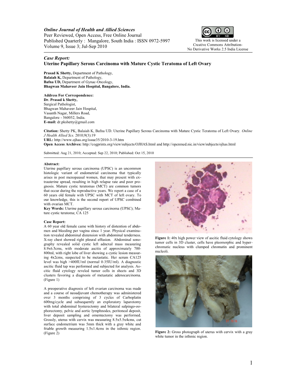 Uterine Papillary Serous Carcinoma with Mature Cystic Teratoma of Left Ovary