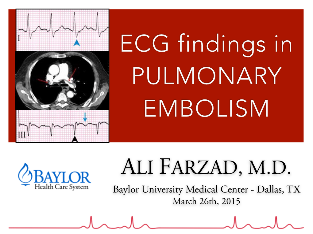 ECG Findings in PULMONARY EMBOLISM