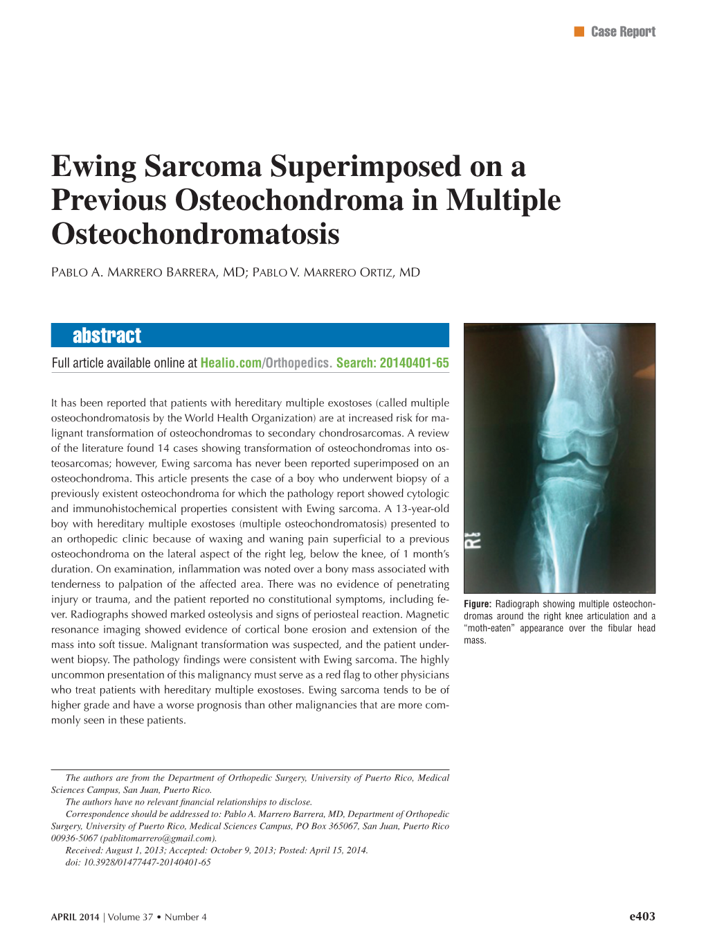 Ewing Sarcoma Superimposed on a Previous Osteochondroma in Multiple Osteochondromatosis