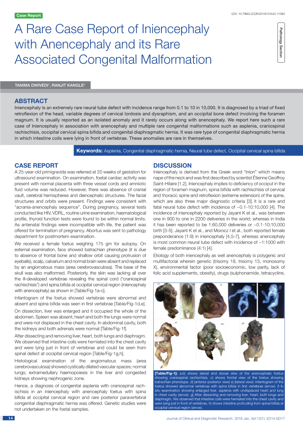 A Rare Case Report of Iniencephaly with Anencephaly and Its Rare Associated Congenital Malformation