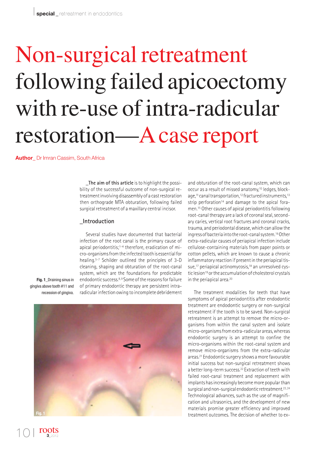 Non-Surgical Retreatment Following Failed Apicoectomy with Re-Use of Intra-Radicular Restoration—A Case Report