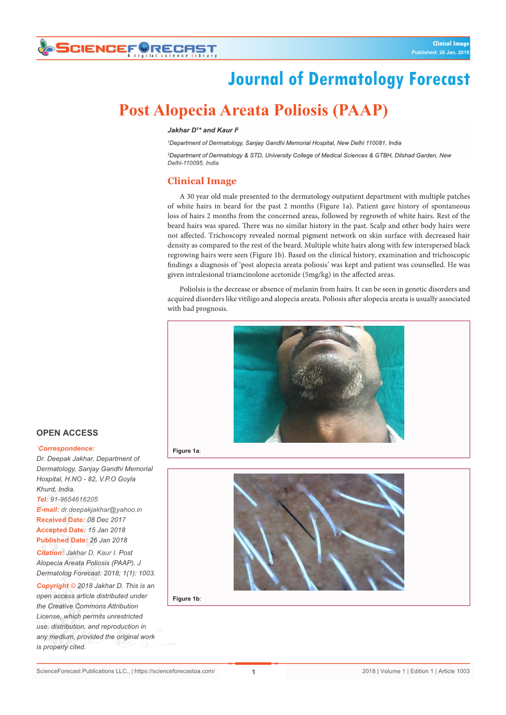 Post Alopecia Areata Poliosis (PAAP)