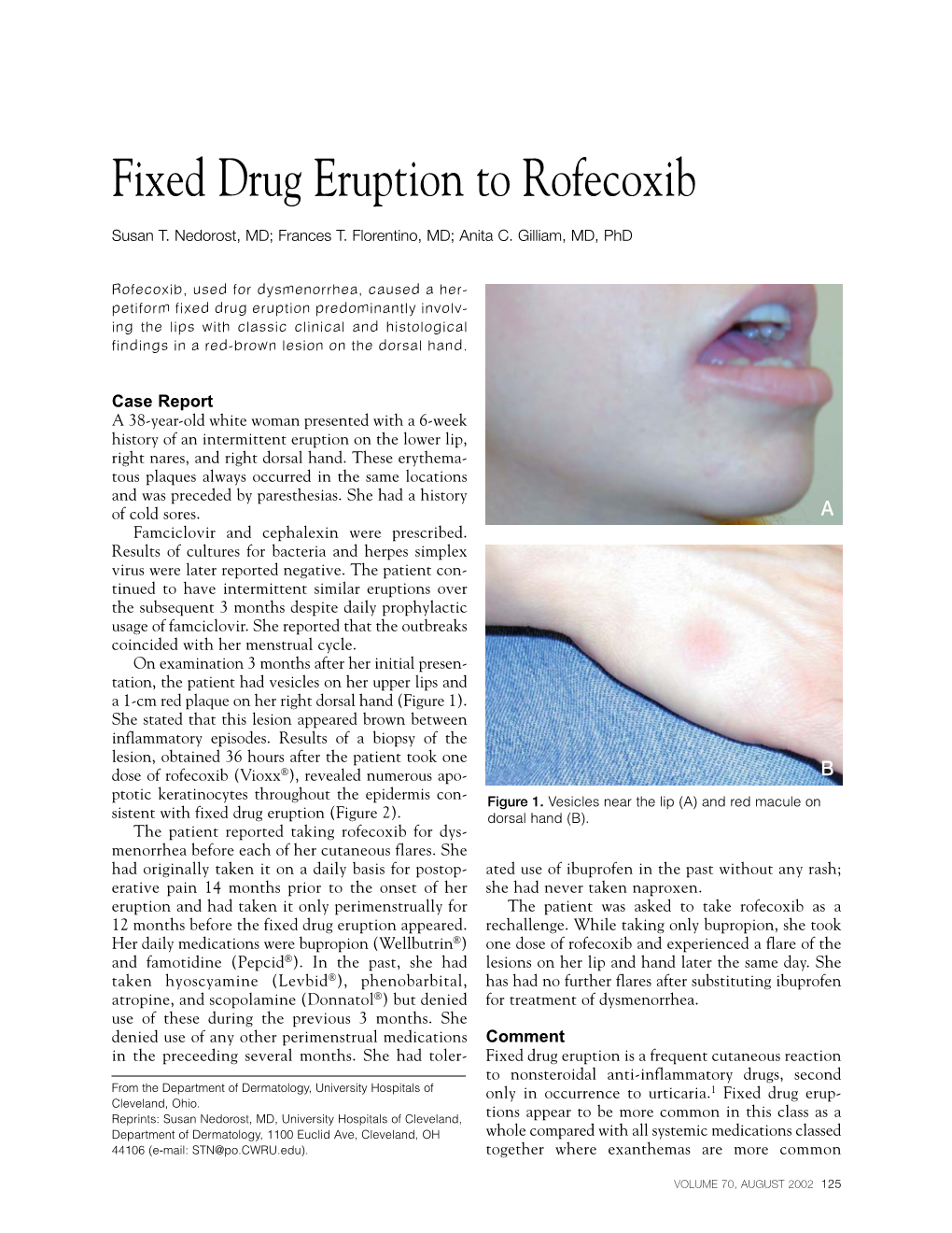 Fixed Drug Eruption to Rofecoxib