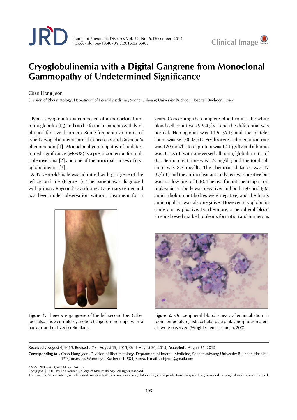 Cryoglobulinemia with a Digital Gangrene from Monoclonal Gammopathy of Undetermined Significance