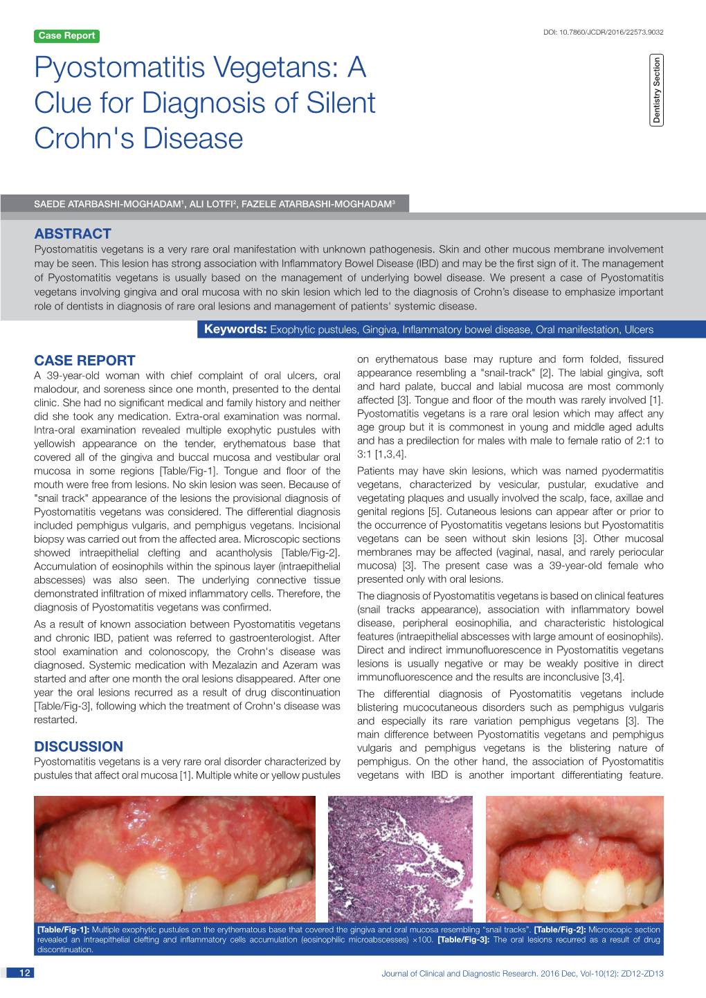 Pyostomatitis Vegetans: a Clue for Diagnosis of Silent Dentistry Section Crohn's Disease