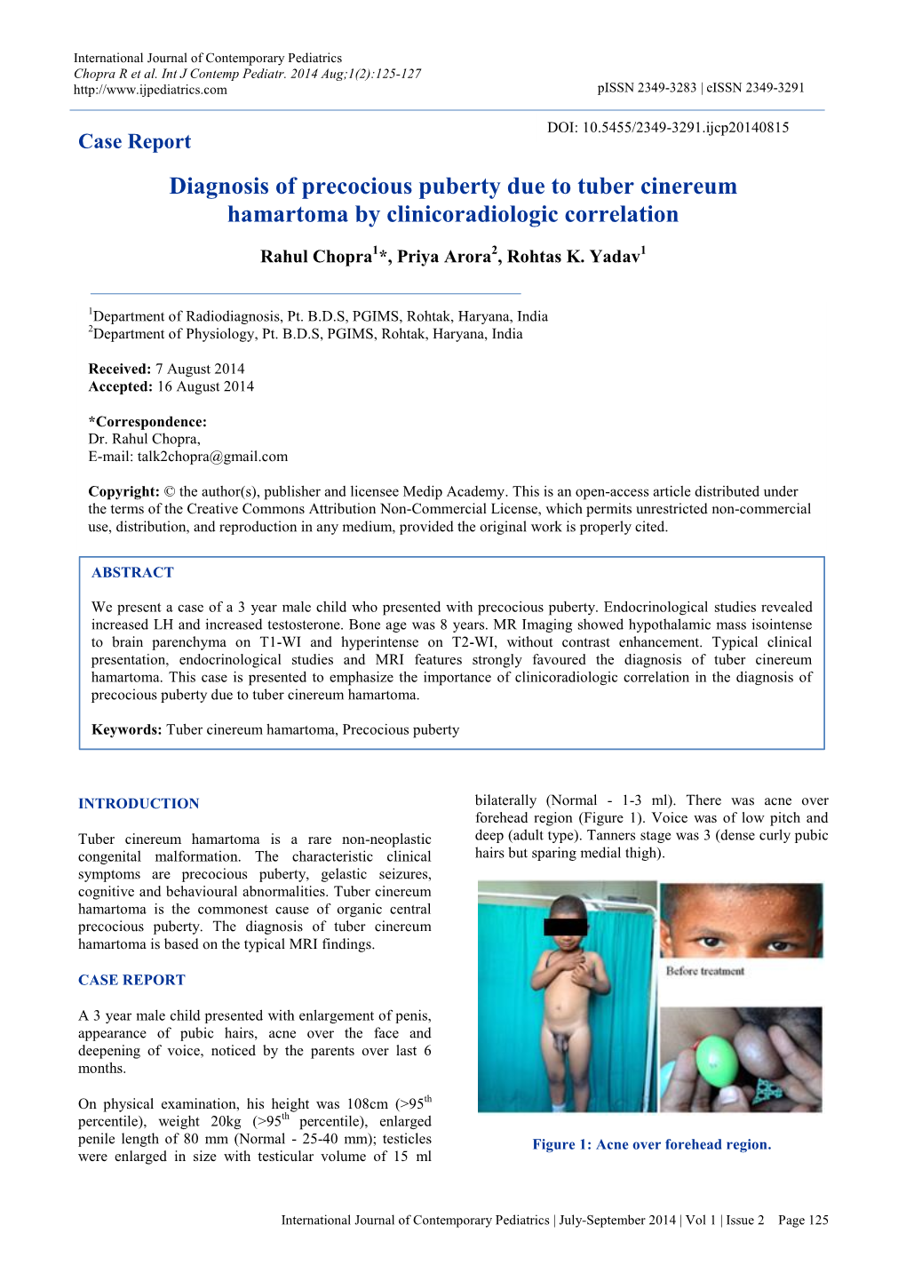 Diagnosis of Precocious Puberty Due to Tuber Cinereum Hamartoma by Clinicoradiologic Correlation