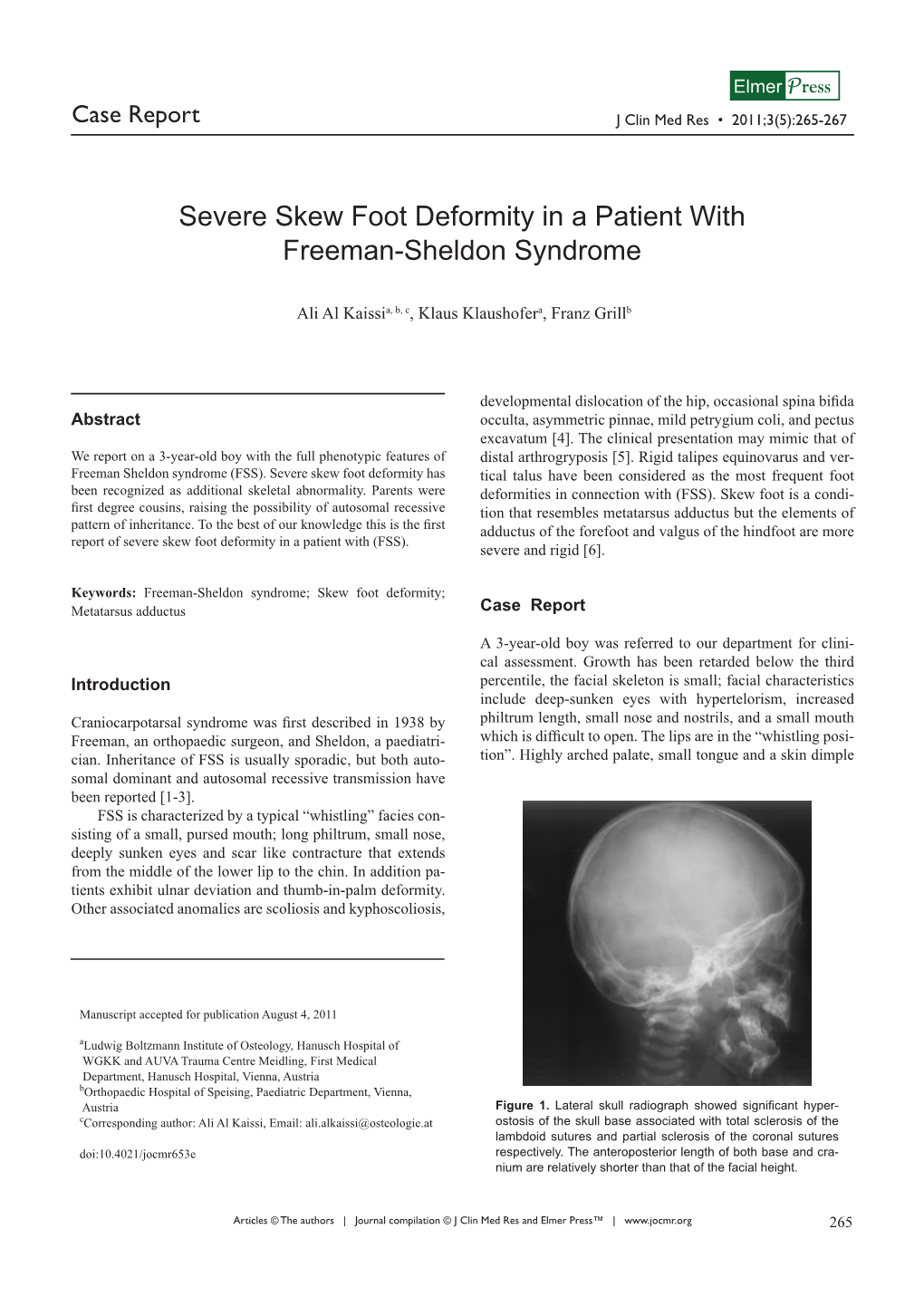 Severe Skew Foot Deformity in a Patient with Freeman-Sheldon Syndrome