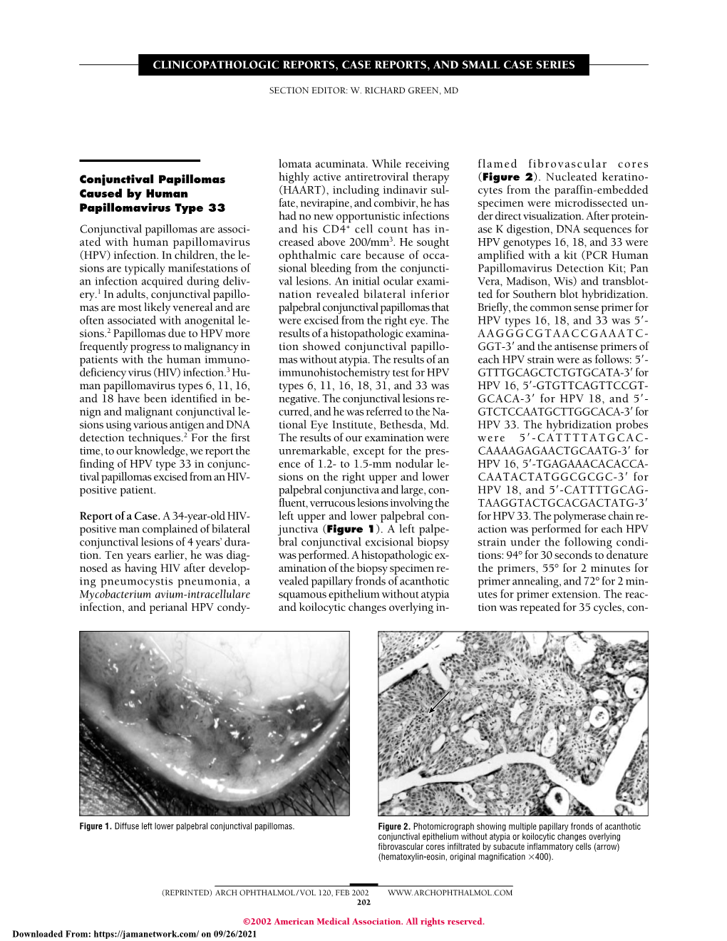 Bilateral Iridociliary T-Cell Lymphoma