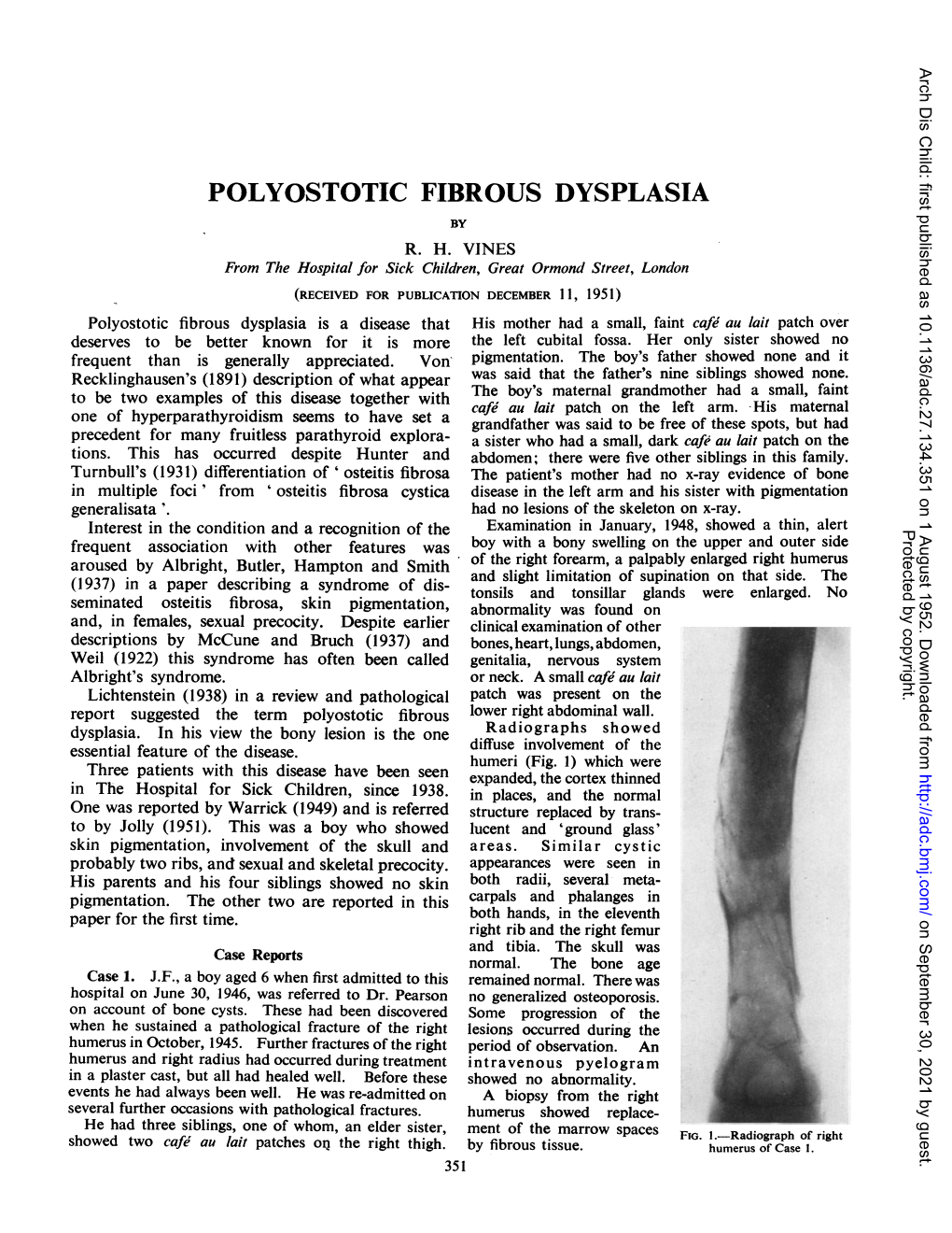 Polyostotic Fibrous Dysplasia by R