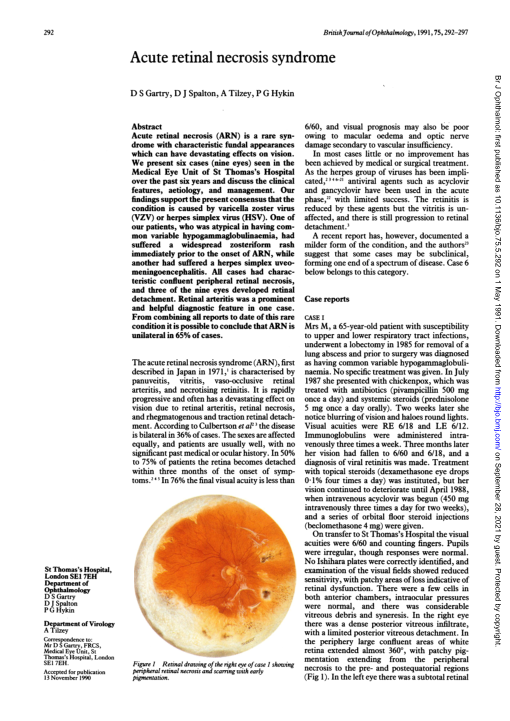 Acute Retinal Necrosis Syndrome Br J Ophthalmol: First Published As 10.1136/Bjo.75.5.292 on 1 May 1991