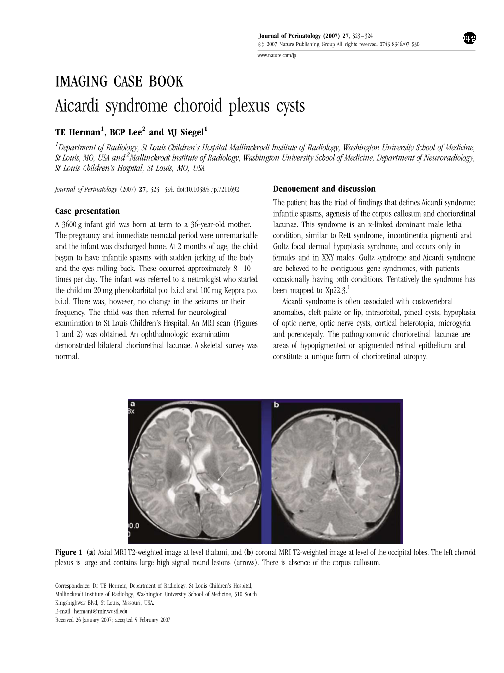 Aicardi Syndrome Choroid Plexus Cysts