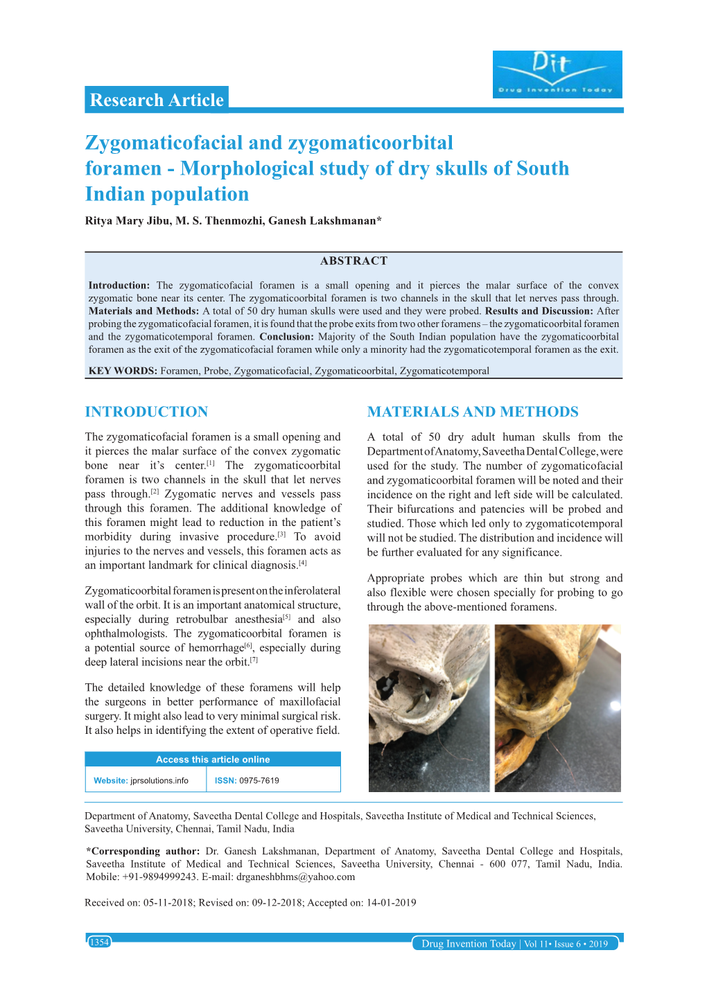 Zygomaticofacial and Zygomaticoorbital Foramen - Morphological Study of Dry Skulls of South Indian Population Ritya Mary Jibu, M