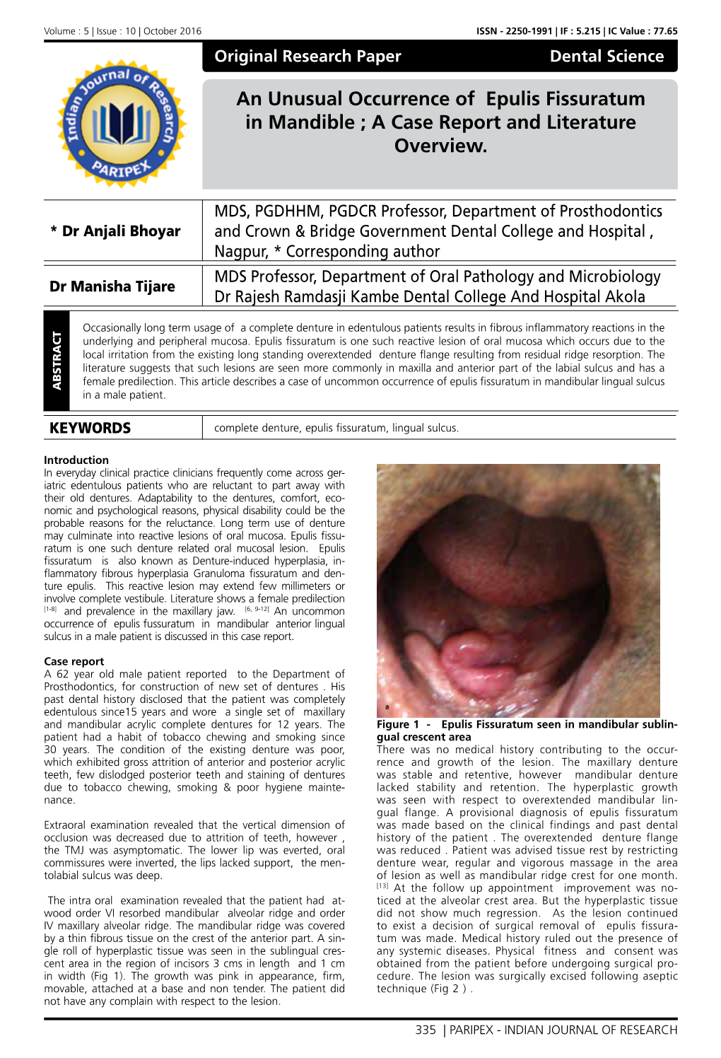 An Unusual Occurrence of Epulis Fissuratum in Mandible ; a Case Report and Literature Overview