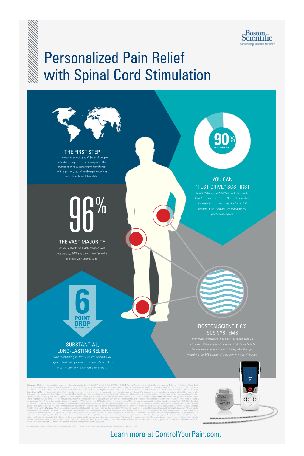 Personalized Pain Relief with Spinal Cord Stimulation