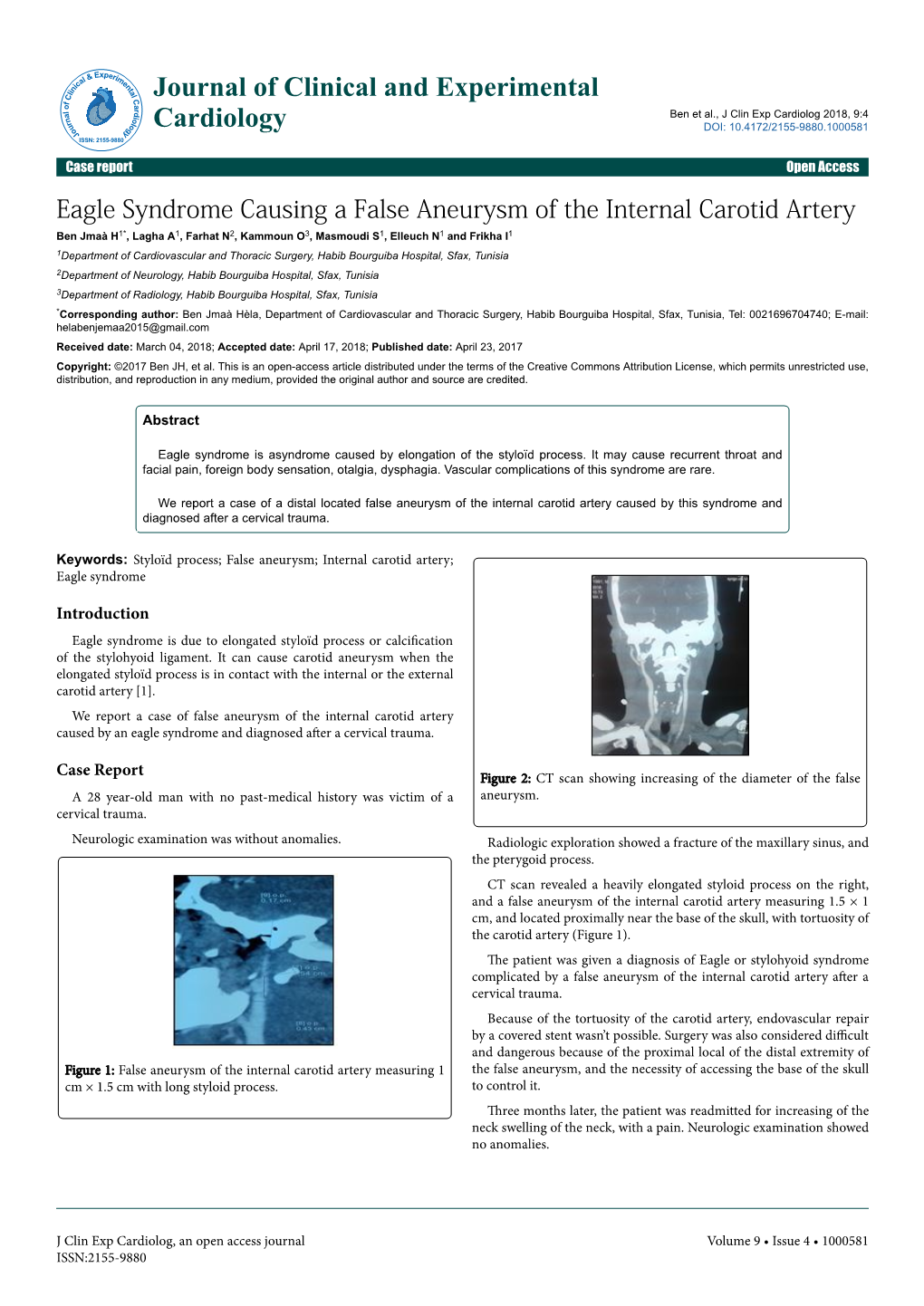 Eagle Syndrome Causing a False Aneurysm of the Internal Carotid Artery