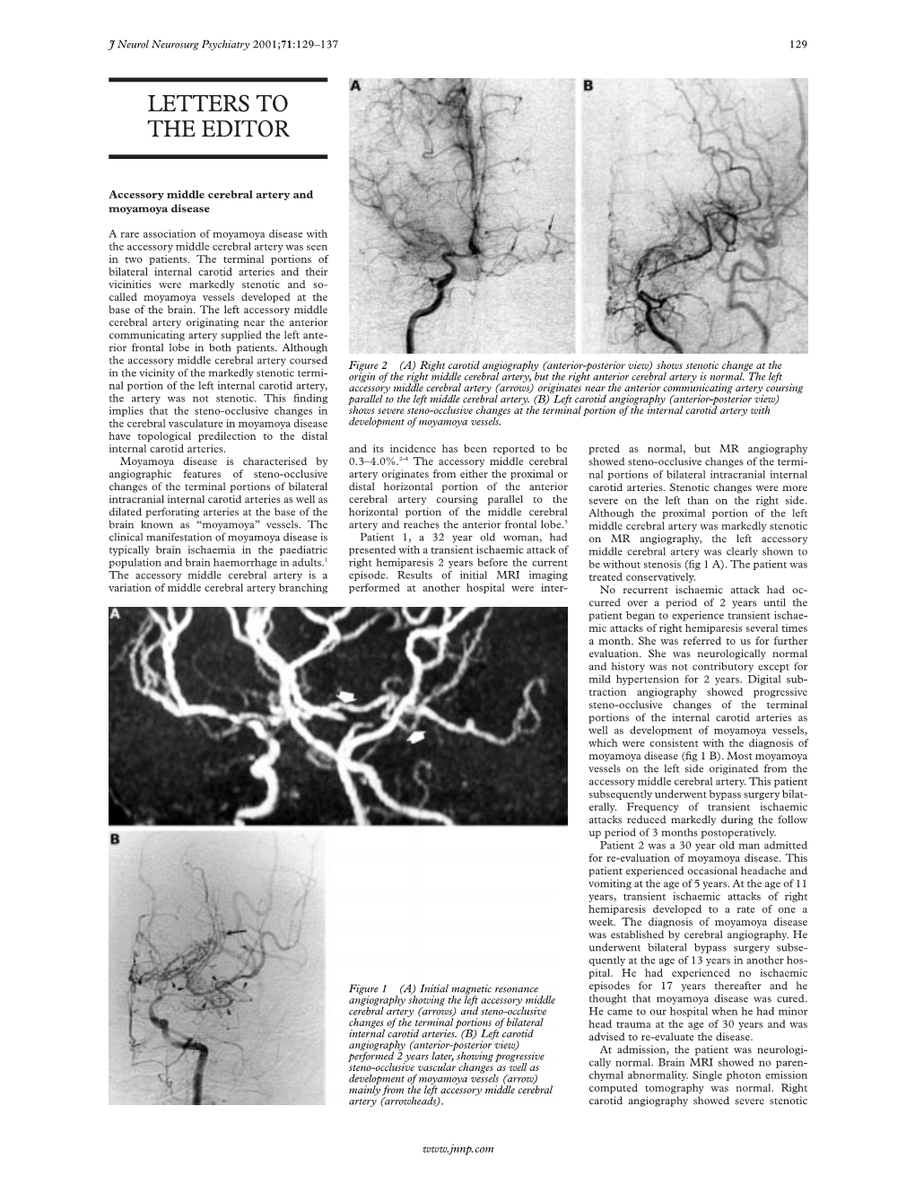 Vascular Dementia Ache, Headache Associated with Disease of the Ways the Most Fascinating