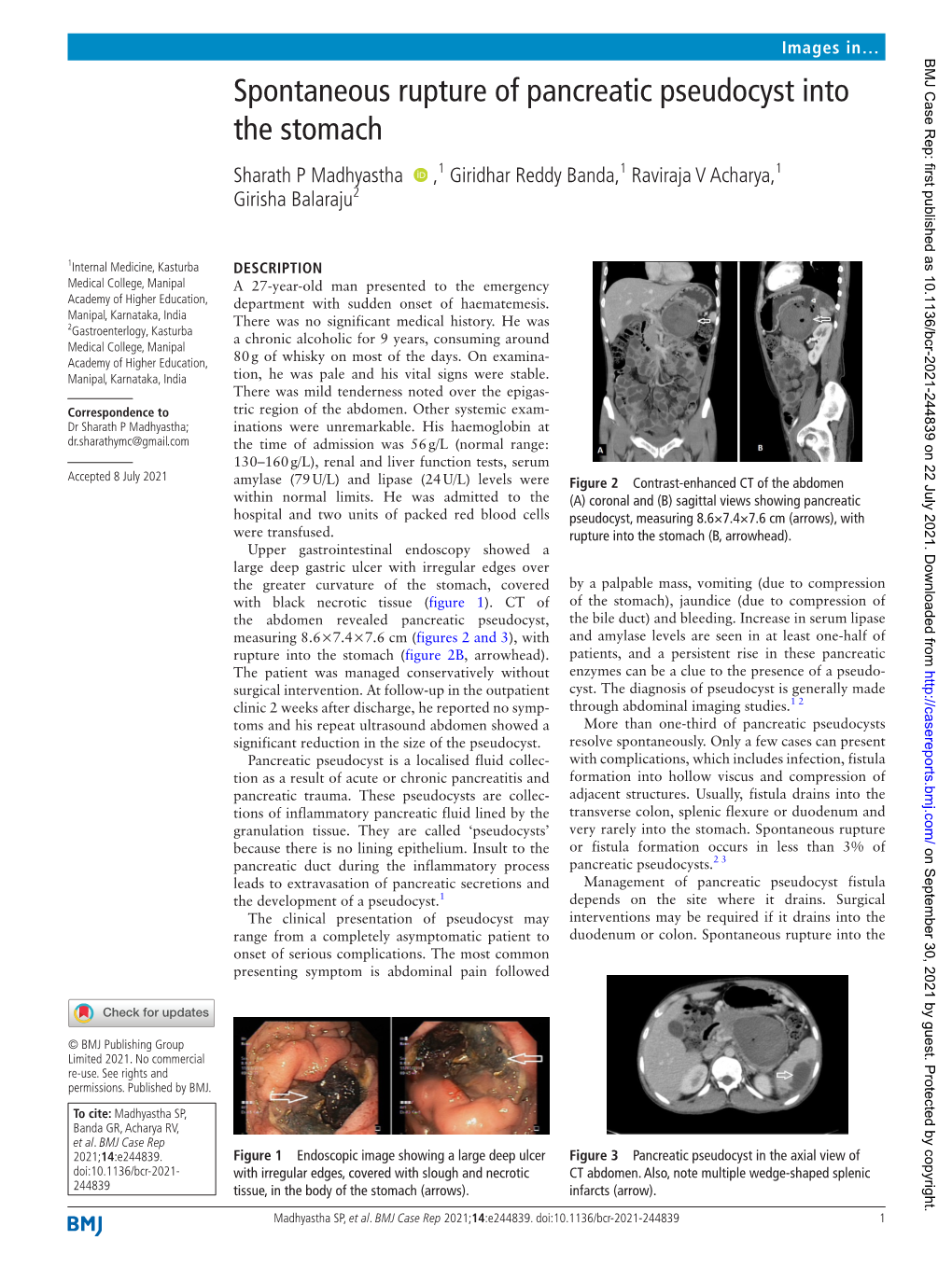 Spontaneous Rupture of Pancreatic Pseudocyst Into the Stomach Sharath P Madhyastha ‍ ‍ ,1 Giridhar Reddy Banda,1 Raviraja V Acharya,1 Girisha Balaraju2