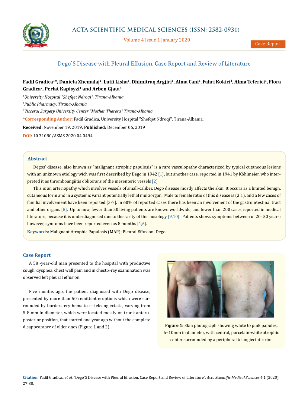 Dego`S Disease with Pleural Effusion. Case Report and Review of Literature