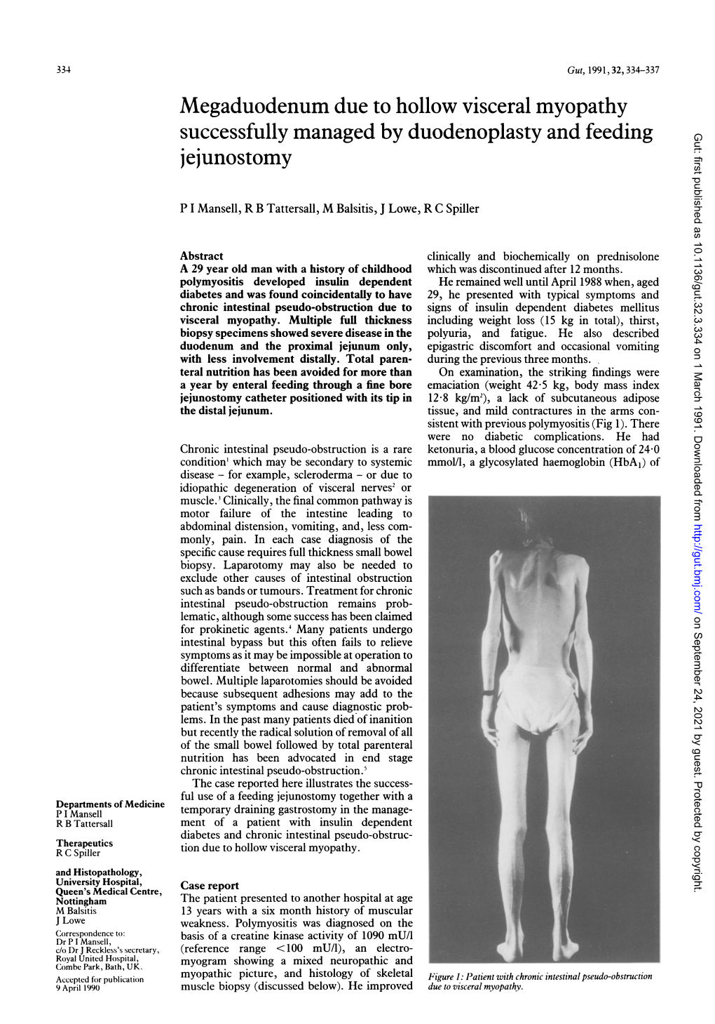 Megaduodenum Due to Hollow Visceral Myopathy Successfully Managed by Duodenoplasty Andfeedingjejunostomy 337