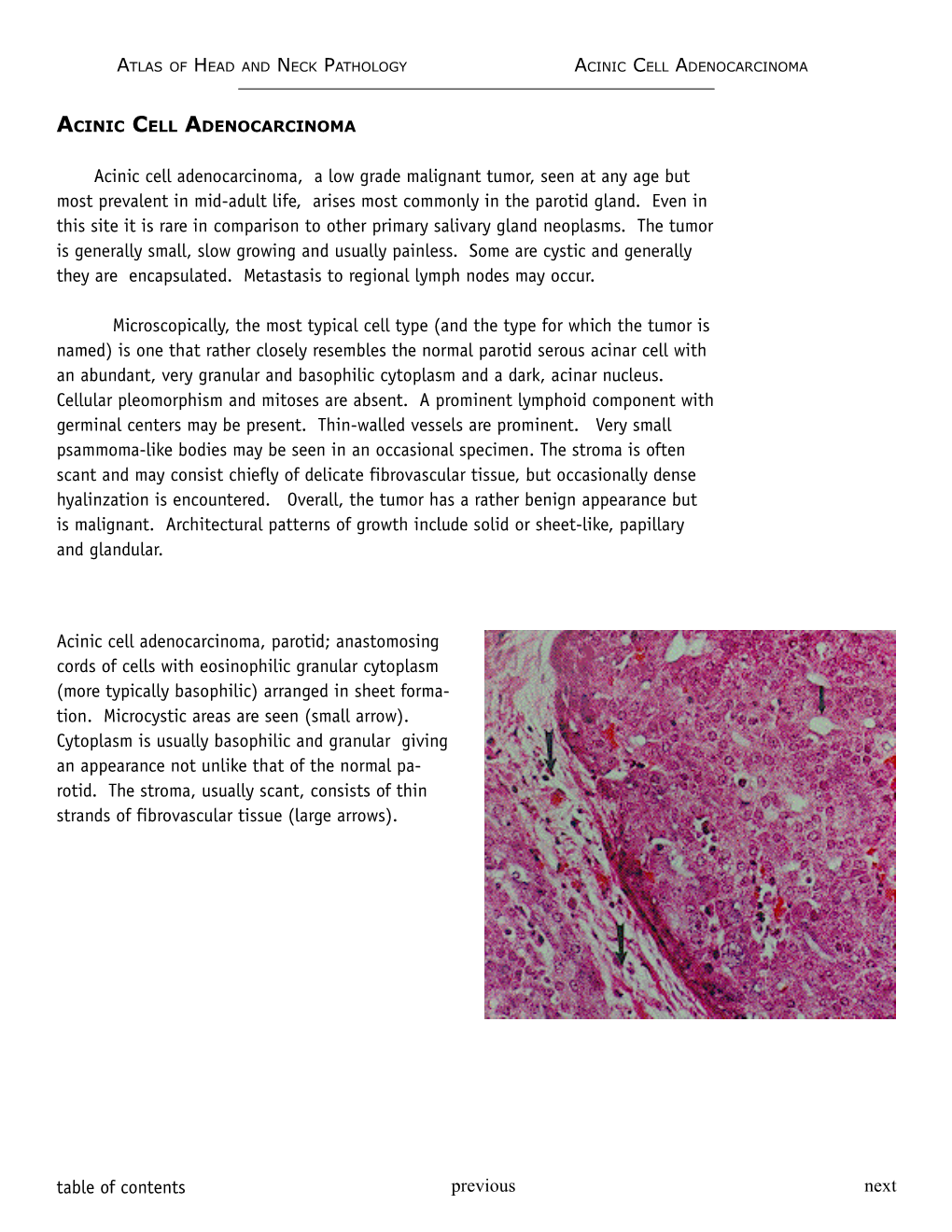 Table of Contents Previous Next Acinic Cell Adenocarcinoma, a Low Grade