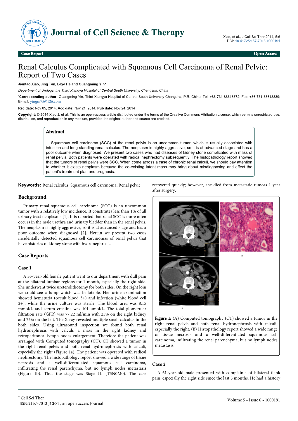 Renal Calculus Complicated With