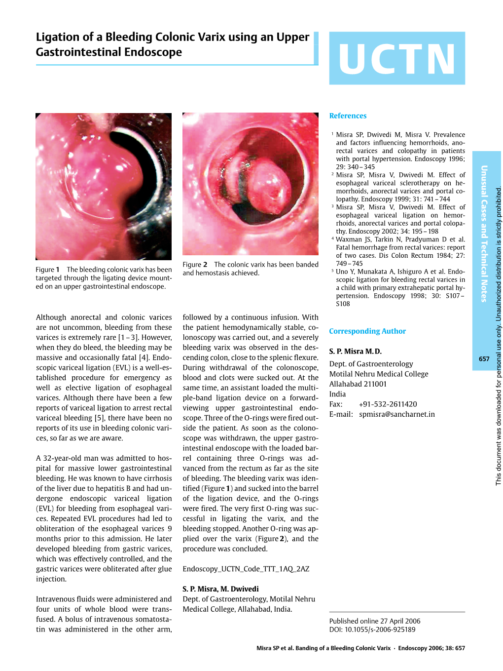 Ligation of a Bleeding Colonic Varix Using an Upper Gastrointestinal Endoscope UCTN