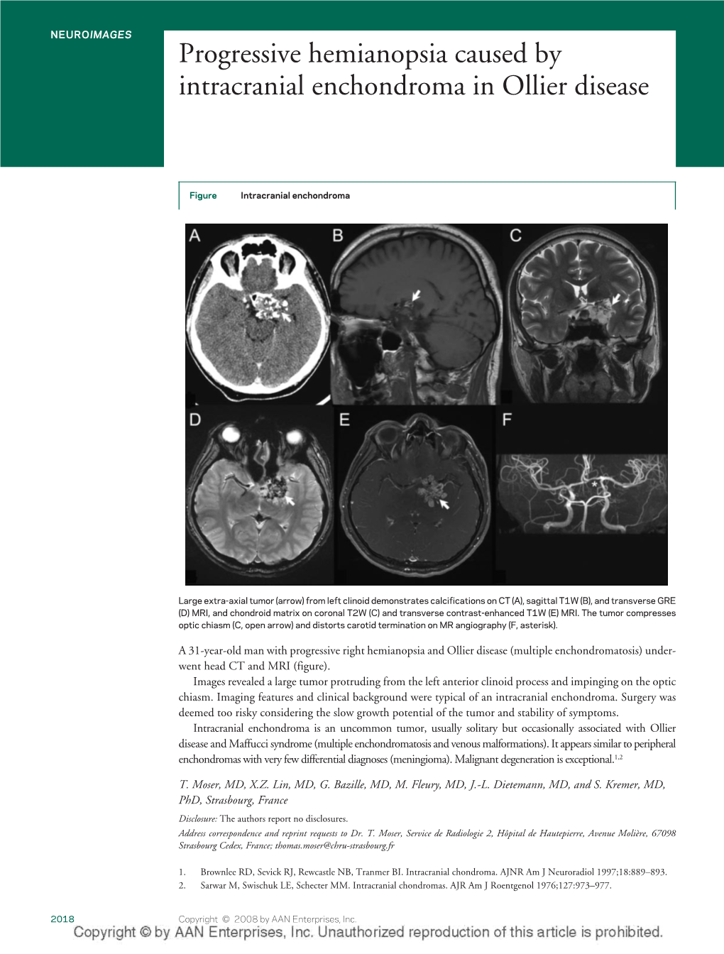 Progressive Hemianopsia Caused by Intracranial Enchondroma in Ollier Disease