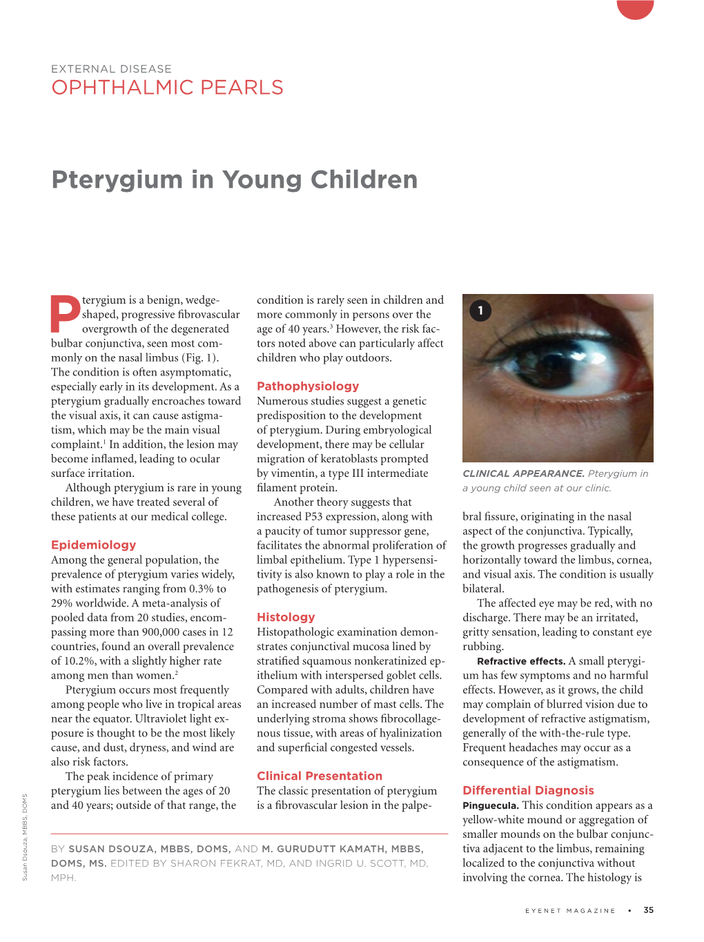 Pterygium in Young Children