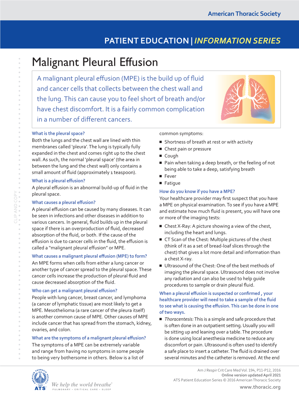 Malignant Pleural Effusion a Malignant Pleural Effusion (MPE) Is the Build up of Fluid and Cancer Cells That Collects Between the Chest Wall and the Lung